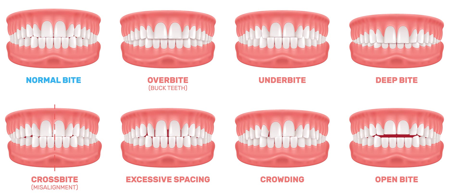 What can Invisalign fix